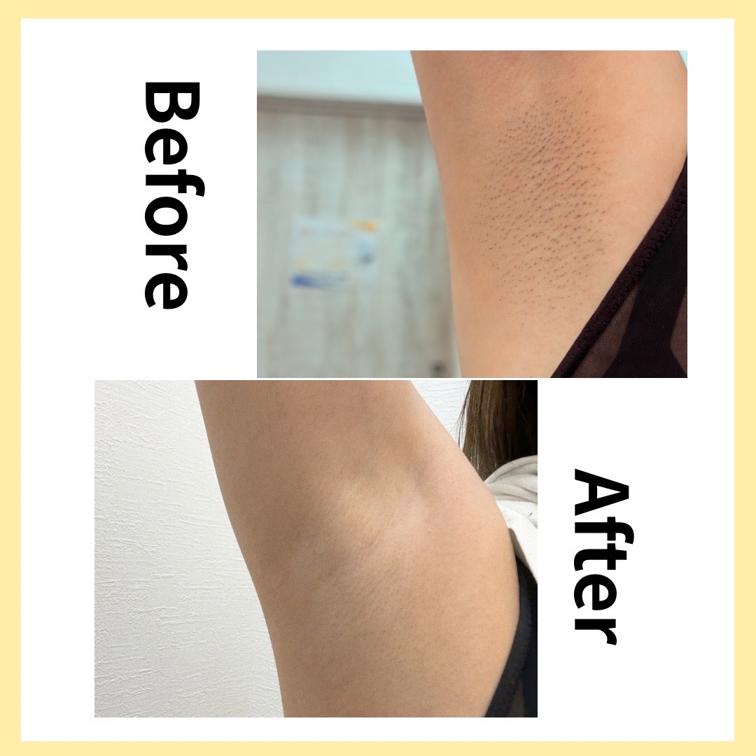 ポツポツとはおさらば🖐️のサムネイル画像