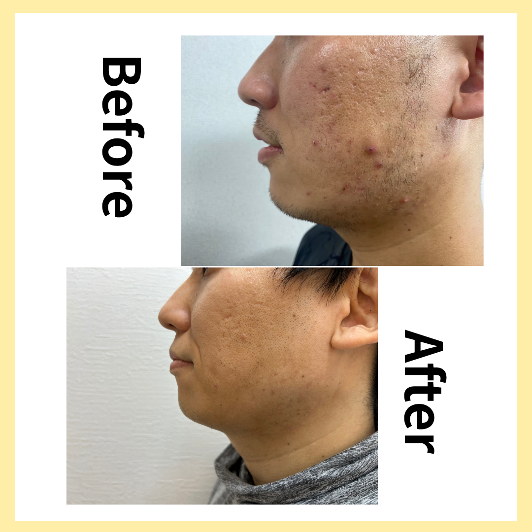 脱毛したら剃刀負けが無くなる⁉️のサムネイル画像