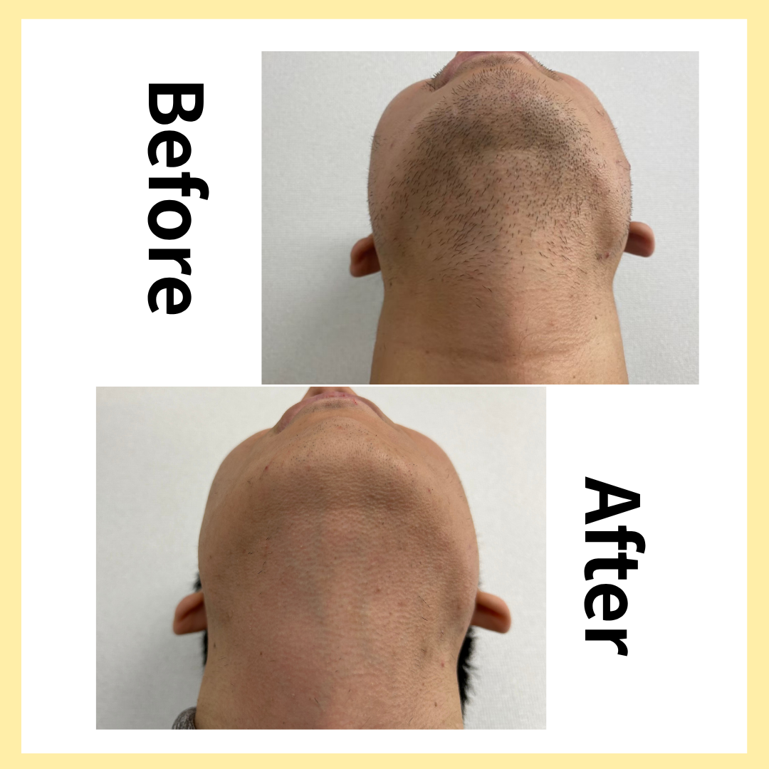 顎から首にかけては絶対したがいい！のサムネイル画像